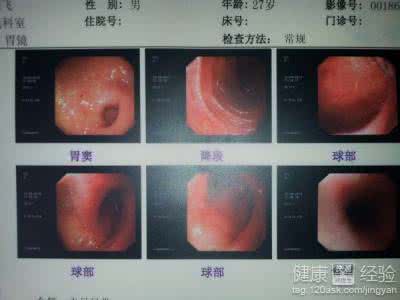 治疗胃溃疡糜烂的偏方 胃溃疡的症状及治疗