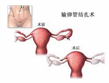 结扎对女人有什么伤害 女人结扎有什么影响