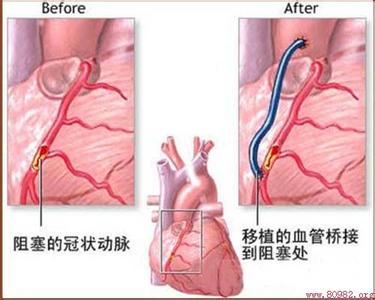 心脏搭桥手术视频 啥叫“心脏搭桥”？视频