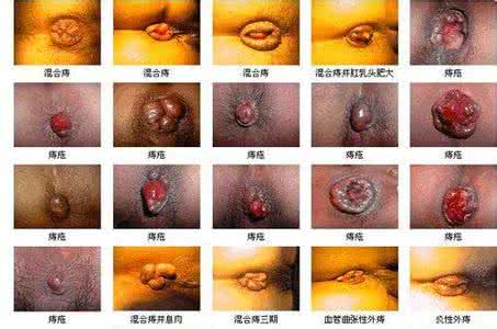 什么原因导致痔疮发作 什么原因导致痔疮
