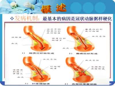 动脉硬化性心脏病 动脉硬化性心脏病食谱的做法大全