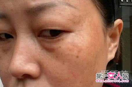 长痘痘可以激光祛斑么 老院长祛斑方是真的吗 长痘不长斑是真的吗？