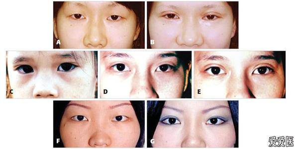 重睑成形术 重睑成形术 高分子重睑成形术