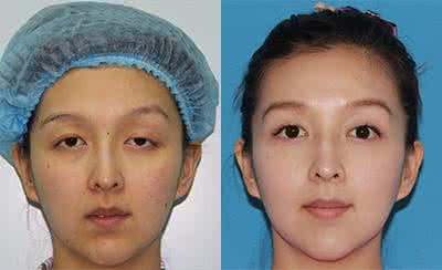 上眼睑下垂偏方 治疗眼睑下垂 你有好偏方吗?