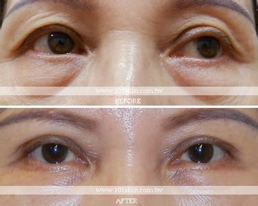 割双眼皮被切上睑 庆 重 睑(双眼皮)