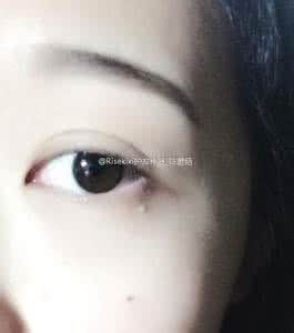 眼袋脂肪粒怎么去掉 眼角长脂肪粒 如何处理眼角脂肪粒