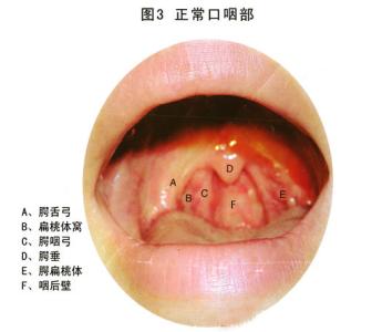 慢性咽炎疗法 慢性咽炎速效疗法