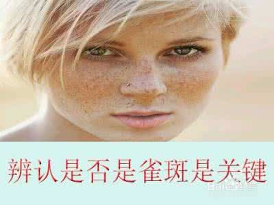 激光去雀斑注意事项 如何去雀斑？去雀斑的注意事项