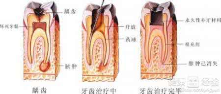 急性牙髓炎吃什么药 急性牙髓炎 什么是急性牙髓炎