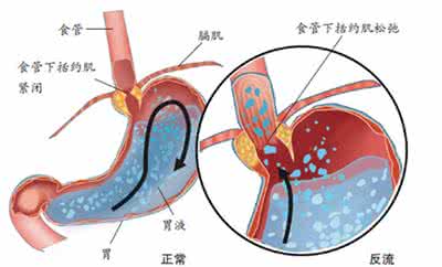 食管癌和返流性食道炎 胃食管返流 胃食道反流的原因