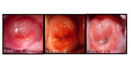 宫颈糜烂3度严重吗 宫颈糜烂3度严重吗 患上宫颈糜烂2度严重吗