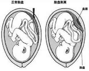 多胎妊娠的护理ppt 多胎妊娠 多胎妊娠如何护理