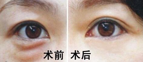 做眼袋祛除术哪好 做眼袋祛除术哪好 下眼袋祛除术