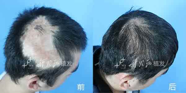 生姜头皮按摩膏有效吗 生姜擦头皮真的有效吗?
