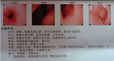 胃镜检查前注意事项 胃镜检查前注意事项 胃镜检查前要注意什么