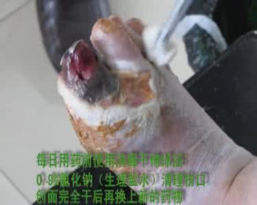 糖尿病烫伤怎么办 转载 糖尿病烫伤不愈合