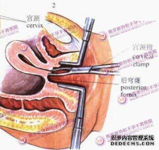 宫外孕表现症状 症状:宫外孕的体征表现