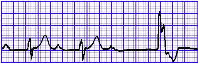 心电图qrs波群代表 心电图QRS波群的五种“变态”行为