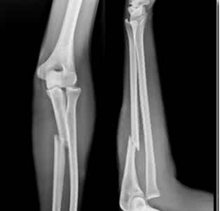 尺骨茎突骨折多久能好 尺骨骨折 尺骨骨折吃什么好