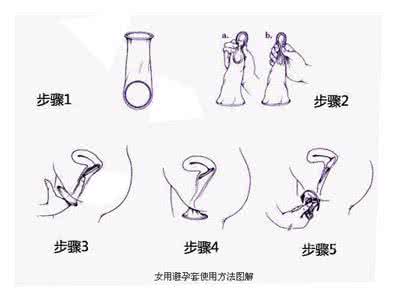 皮下埋植避孕法 初夜如何选用避孕法