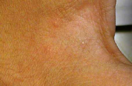 疥疮能根治吗 疥疮 疥疮能根治吗？