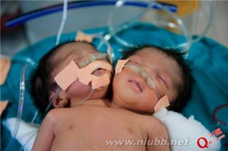 美国恐怖故事双头姐妹 震惊 孕期这事没做竟生出双头婴儿