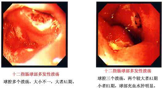 胃十二指肠溃疡出血 胃及十二指肠溃疡出血2方