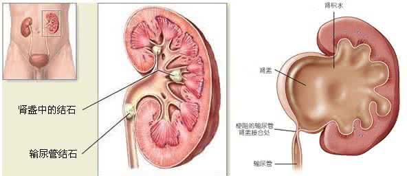 肾积水的症状 肾积水的症状 这些情况就是肾积水