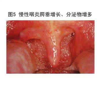 民间治疗咽喉炎 民间土方治疗慢性咽喉炎