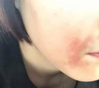 面部黑色素沉淀 面部黑色素沉淀怎么办?