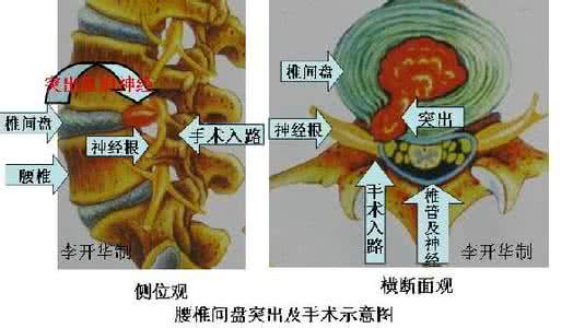 做腰椎间盘突出手术 腰椎间盘突出，别轻易手术！