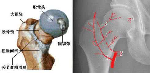 治疗股骨头坏死有好要 股骨头坏死能治好吗 科学治疗股骨头坏死