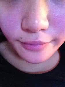 点完痣有坑 点完痣有坑 如何能把痣坑?