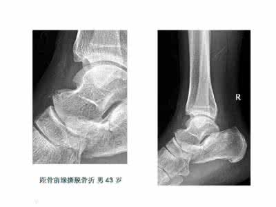 永存骨骺 【实用】籽骨、副骨、永存性骨骺和撕脱性骨折