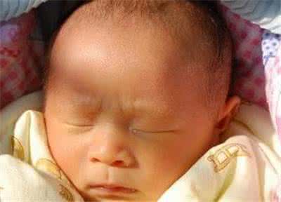 新生儿生理性黄疸症状 新生儿生理性黄疸 新生儿黄疸--生理性黄疸