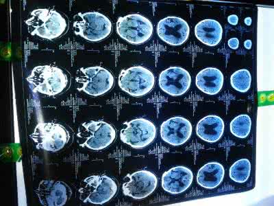 治疗脑萎缩的特效药 治疗脑萎缩特效方