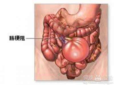 结肠癌的症状及治疗 结肠癌的早期症状 如何治疗结肠癌