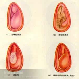长期鼻炎的危害有哪些 鼻炎的特征有哪些
