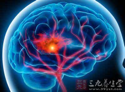认知能力下降 研究称卒中会加速患者的认知能力下降