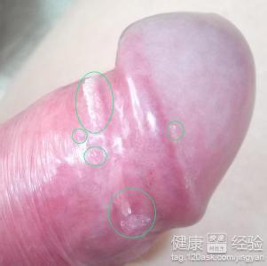 包皮炎的病因及治疗 包皮炎是啥?包皮炎的病因