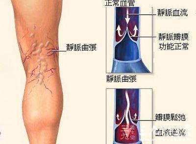 女性下肢静脉曲张 女性双下肢静脉曲张怎么办？