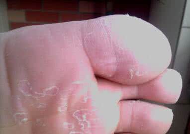 偏方治疗银屑病 皮肤科偏方 哪些偏方可治疗银屑病