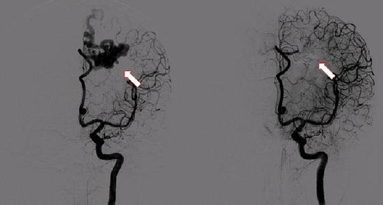 脑血管造影适应症 脑血管造影 脑血管造影有什么适应症