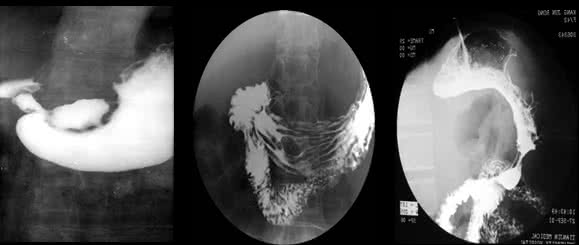 心脏造影是什么检查 心脏造影检查 什么是心脏造影检查