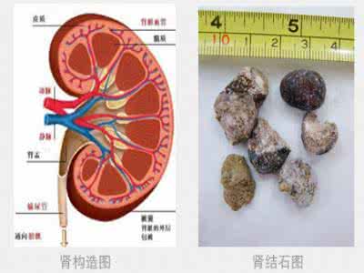 这些食物可催生肾结石 如何预防肾结石 六类食物“催生”肾结石