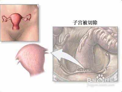 葡萄胎治疗方法 有关治疗葡萄胎的方法介绍