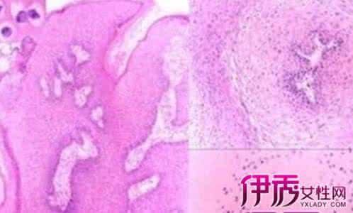 如何治疗湿疹才能根治 根治尖锐湿疣 怎样治疗尖锐湿疣才能根治