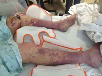 血栓性血小板减少紫癜 血栓性血小板减少性紫癜 其发病机制是什么