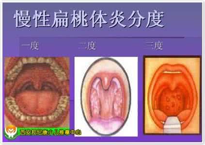 治扁桃体发炎的偏方 治扁桃体奇效秘方