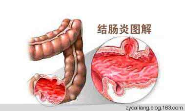 结肠炎的症状及治疗 【转载】结肠炎治疗一绝